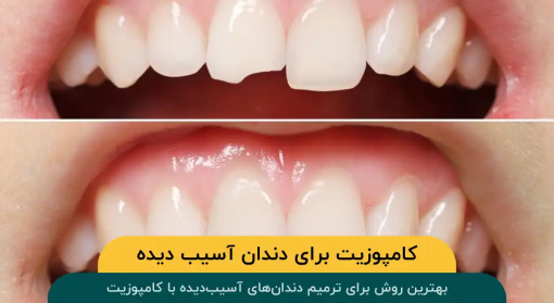 کامپوزیت-دندان-آسیب-دیده